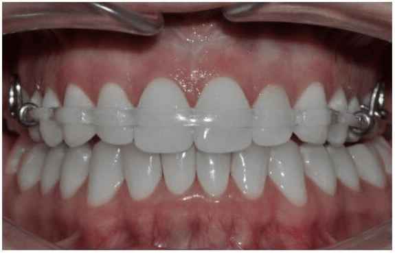 透明維持器-日本進口-隱適美維持器