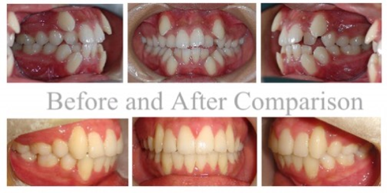 台中隱適美-吸血鬼男孩