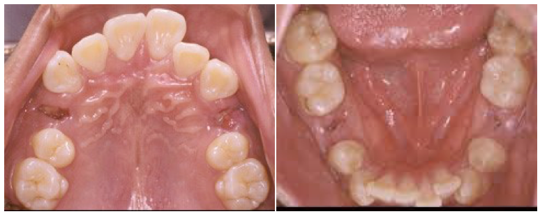 牙齒矯正拔不拔牙? 傳統牙齒矯正拔除小臼齒