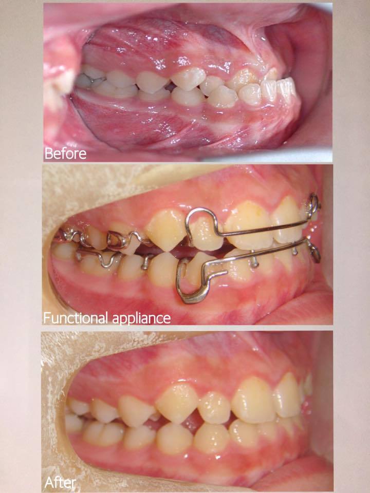 兒童戽斗矯正案例-矯正前後牙齒咬合比較-矯正2個月即有明顯變化
