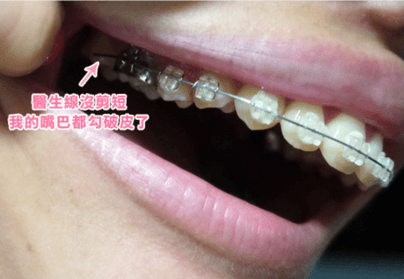 隱適美缺點 隱適美v S Damon 戴蒙矯正器優缺點大評比 Dr 珊 隱適美隱形矯正專家 台中牙齒矯正推薦牙醫