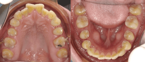 隱適美缺點 隱適美v S Damon 戴蒙矯正器優缺點大評比 Dr 珊 隱適美隱形矯正專家 台中牙齒矯正推薦牙醫