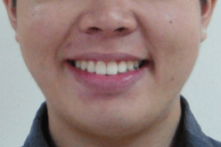 隱適美-戴蒙矯正器-優缺點