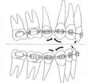 隱適美隱形牙套矯正流程-前牙掉落的副作用Bowing-effect