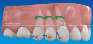 隱適美隱形牙套矯正流程-Optimized-attachment避免牙齒傾倒後退