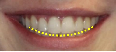 隱適美隱形牙套矯正流程-微笑曲線示意圖