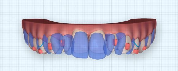 隱適美隱形牙套矯正流程-暴牙矯正押入前後比較圖