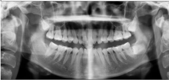 隱適美隱形牙套矯正流程-矯正前X光片記錄