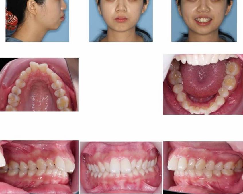 隱適美隱形牙套矯正流程-矯正前針對外觀及口內牙齒做記錄