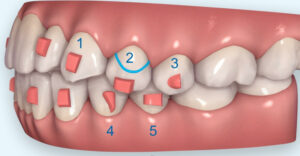 隱適美隱形牙套矯正流程-隱適美小附件說明圖