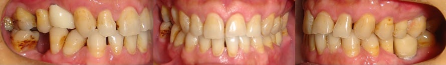 隱適美Lite案例6-牙周病需植牙-空間不佳用Invisalign Lite調整-調整前-台中隱適美推薦