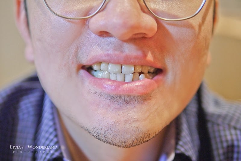 隱適美隱形牙套日記-invisalign-戴蒙矯正器-牙齒矯正心得比較-Angus原本牙齒狀況