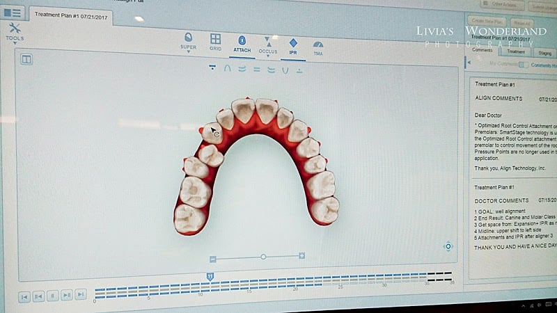 隱適美隱形牙套日記-invisalign-戴蒙矯正器-牙齒矯正心得比較-也可以看到牙齒排列的進步