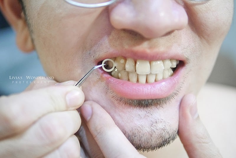 隱適美隱形牙套日記-invisalign-戴蒙矯正器-牙齒矯正心得比較-依狀況會裝上輔助器-attachment豆豆