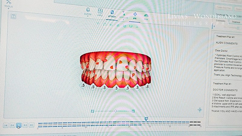 隱適美隱形牙套日記-invisalign-戴蒙矯正器-牙齒矯正心得比較-原廠規劃出的Invisalign矯正進程