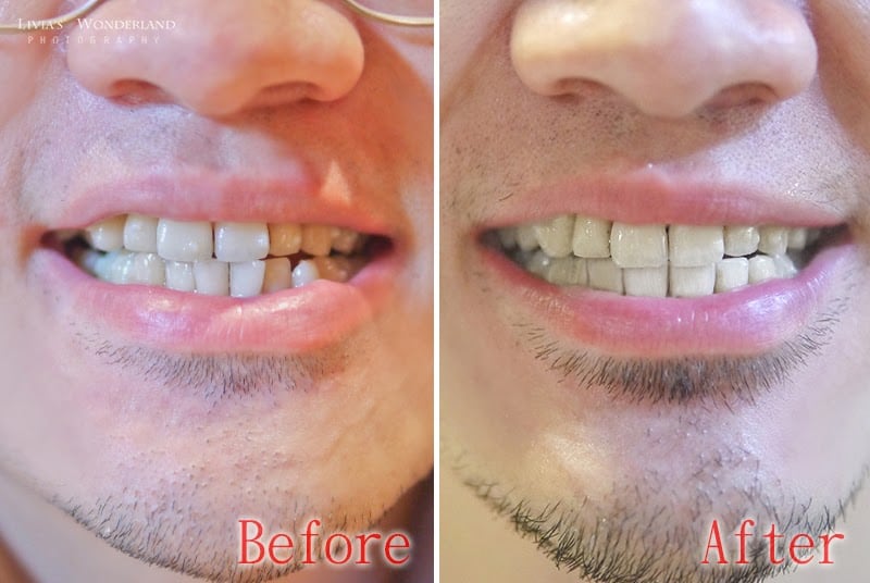 隱適美隱形牙套日記-invisalign-戴蒙矯正器-牙齒矯正心得比較-戴隱適美一年半的前後比較圖