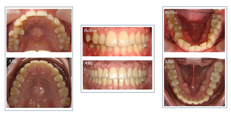 隱適美隱形牙套日記-invisalign-戴蒙矯正器-牙齒矯正心得比較-戴隱適美一年半的口腔牙齒近照前後比較