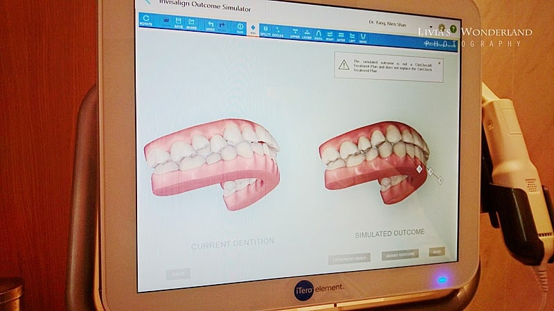 隱適美隱形牙套日記-invisalign-戴蒙矯正器-牙齒矯正心得比較-掃完後立刻運算出矯正流程與結果