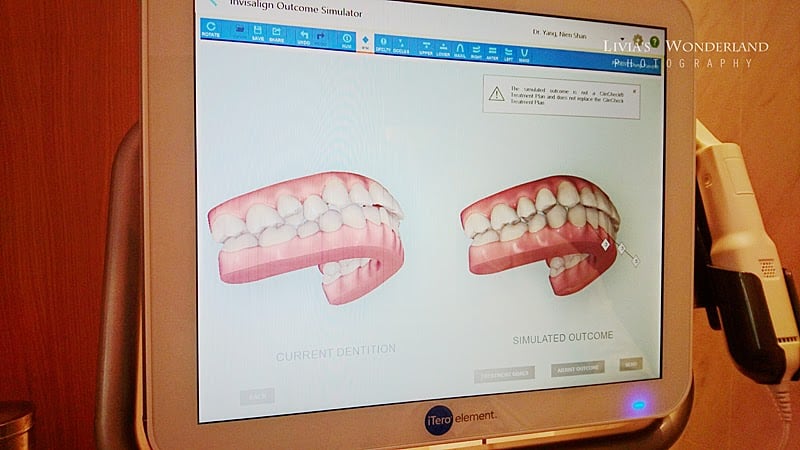隱適美隱形牙套日記-invisalign-戴蒙矯正器-牙齒矯正心得比較-掃完後立刻運算出矯正流程與結果