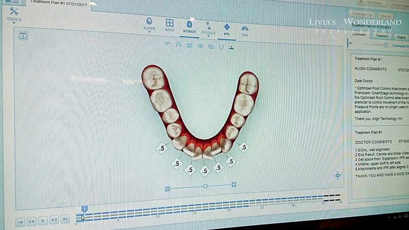 隱適美隱形牙套日記-invisalign-戴蒙矯正器-牙齒矯正心得比較-有動畫看到每副牙套的改變