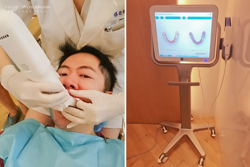 隱適美隱形牙套日記-invisalign-戴蒙矯正器-牙齒矯正心得比較-隱適美專用3D口掃機