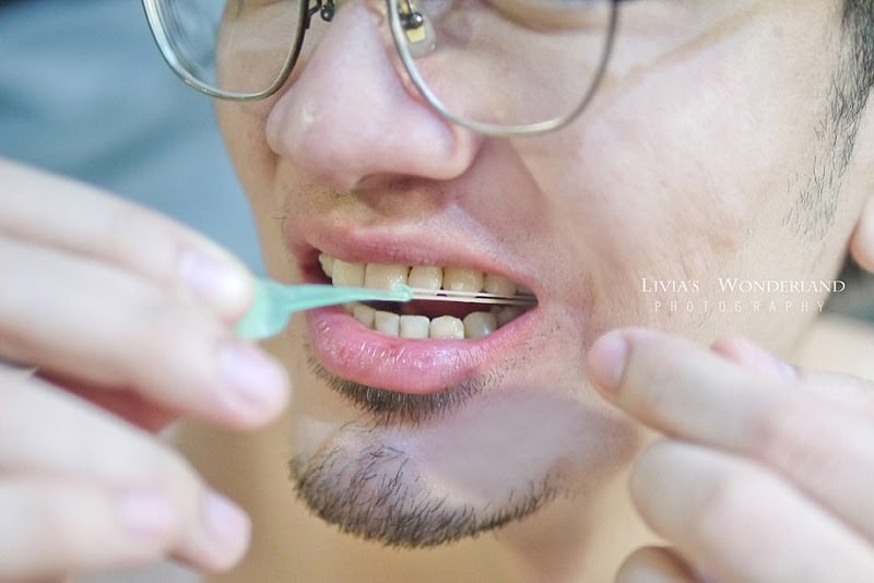 隱適美隱形牙套日記-invisalign-戴蒙矯正器-牙齒矯正心得比較-隱適美橡皮筋