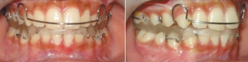 兒童牙齒矯正黃金期是何時 牙齒矯正的藝術 Dr 珊 台中隱適美隱形矯正