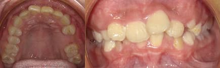 兒童牙齒矯正案例-牙齒長不出來或長太醜