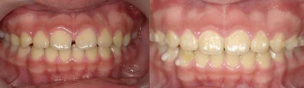 兒童牙齒矯正黃金期-暴牙矯正-戽斗矯正-mrc矯正-兒童牙齒矯正案例-門牙有縫的矯正