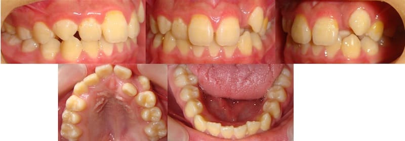 兒童牙齒矯正案例-齒列不正矯正前的各角度牙齒狀況