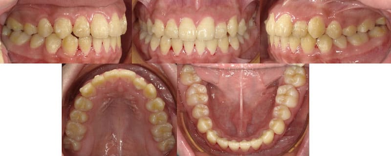 兒童牙齒矯正案例-齒列不正矯正後的各角度牙齒狀況