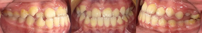 戽斗矯正案例-有前牙反咬及舌頭位置不佳問題