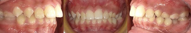 暴牙矯正案例-矯正前有下顎後縮與深咬問題