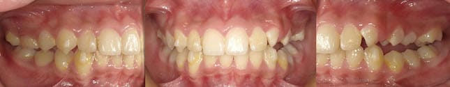 暴牙矯正案例-配戴MA十個月後暴牙和深咬改善