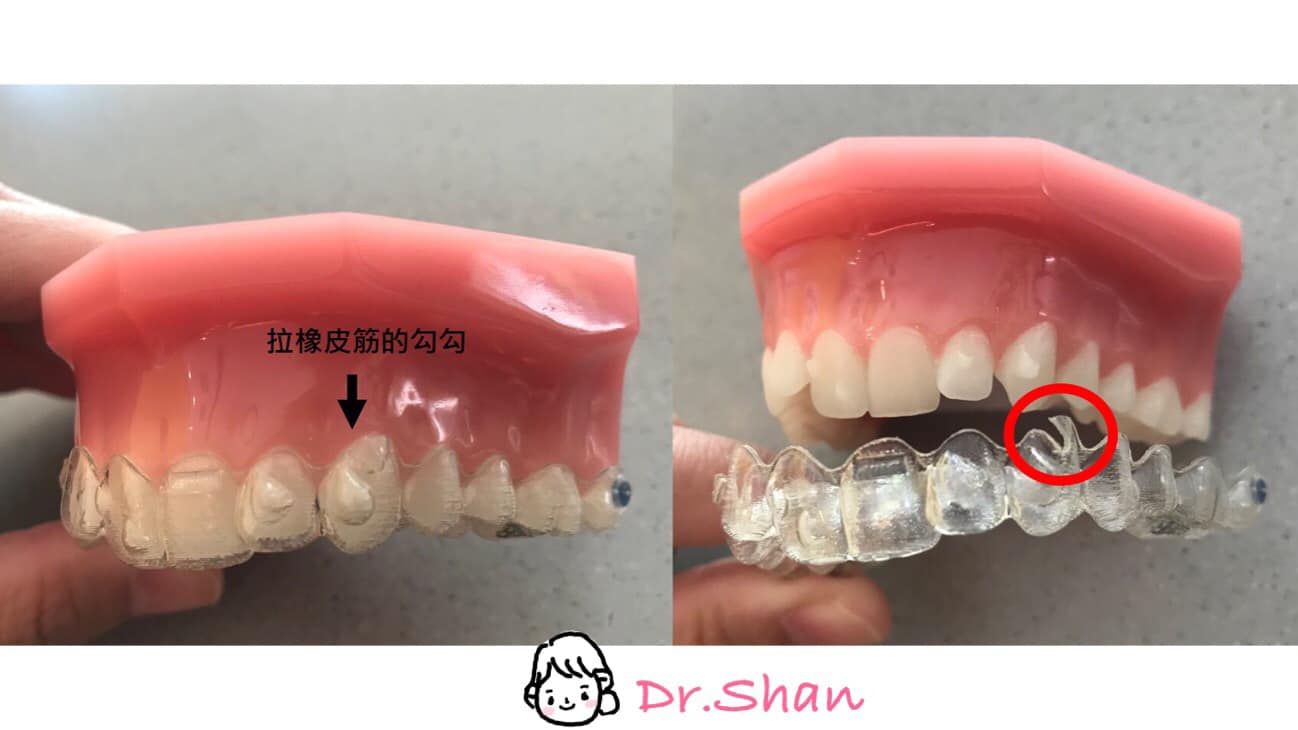 隱適美戴橡皮筋前 要先檢查牙套上的 紐扣洞 隱形矯正全攻略