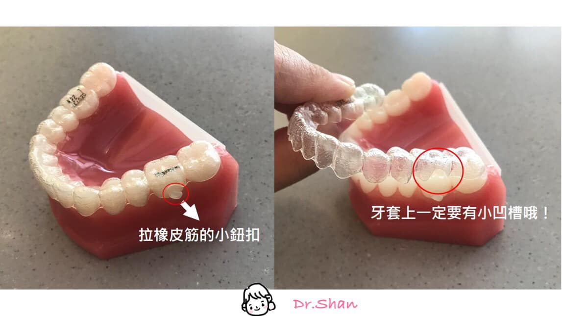 隱適美戴橡皮筋前 要先檢查牙套上的 紐扣洞 隱形矯正全攻略
