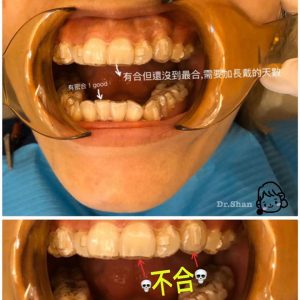 隱適美牙套不合彙整 Dr 珊 隱適美隱形矯正專家 台中牙齒矯正推薦牙醫