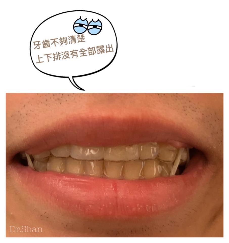 肺炎疫情-國外病人-隱適美無法回診拍照確認-牙齒不夠清楚