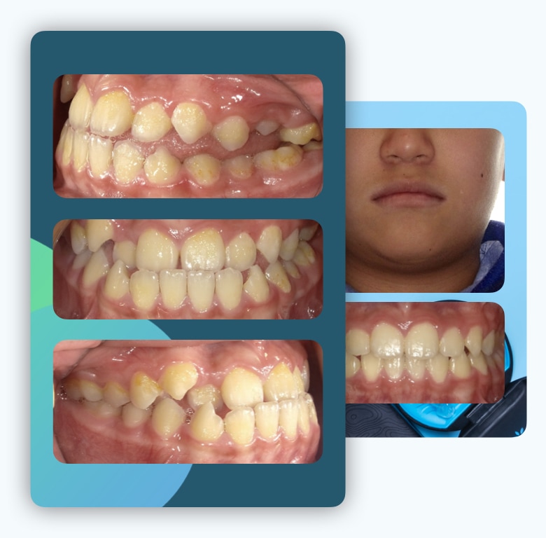 隱適美-兒童隱適美-反咬-Invisalign-first-台中-隱形矯正-牙醫-推薦-楊念珊