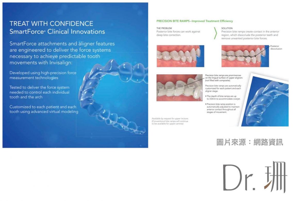 Bite Ramp Invislign 專為矯正深咬設計的隱適美【bite ramp】,輕鬆達到咬合調整- Dr.珊
