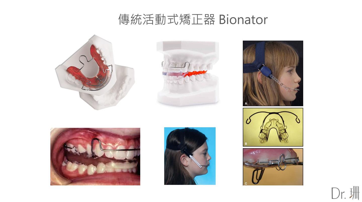傳統活動式矯正器-兒童隱適美-台中-兒童牙齒矯正-隱適美-Dr.珊