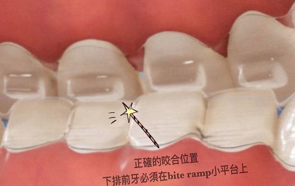 專為矯正深咬設計的隱適美【bite ramp】,輕鬆達到咬合調整 專為矯正深咬設計的隱適美【bite ramp】,輕鬆達到咬合調整