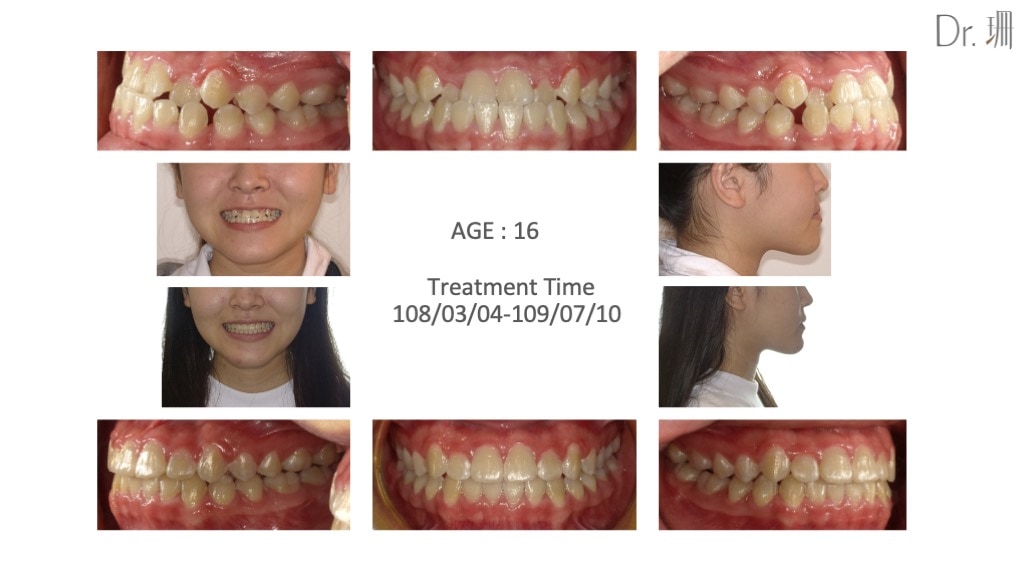 隱適美-兒童隱適美-隱形矯正-反咬-戽斗-牙齒矯正前後-牙齒變化-台中-楊念珊