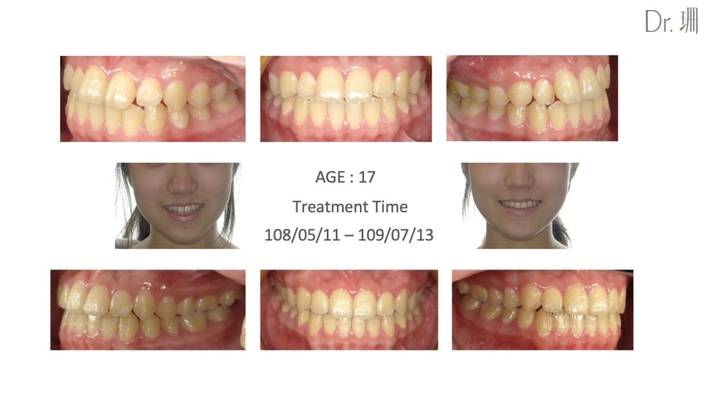 隱適美-兒童隱適美-隱形矯正-反咬-門牙微亂-牙齒矯正前後-牙齒變化-台中-楊念珊