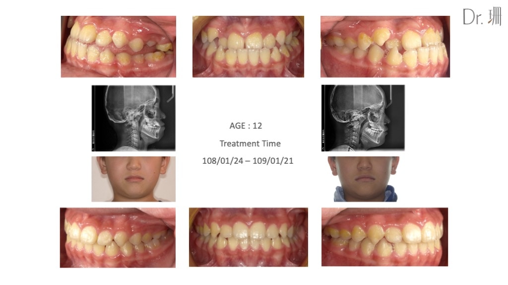 隱適美-兒童隱適美-隱形矯正-戽斗-反咬-牙齒矯正前後-牙齒變化-台中-楊念珊