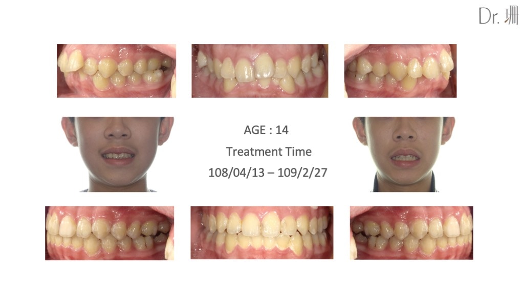 隱適美-兒童隱適美-隱形矯正-深咬-齒列凌亂-咬合歪斜-牙齒矯正前後-牙齒變化-台中-楊念珊