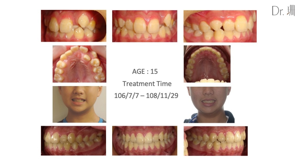 隱適美-兒童隱適美-隱形矯正-牙齒縫隙大-反咬-高位犬齒-牙齒矯正前後-牙齒變化-台中-楊念珊
