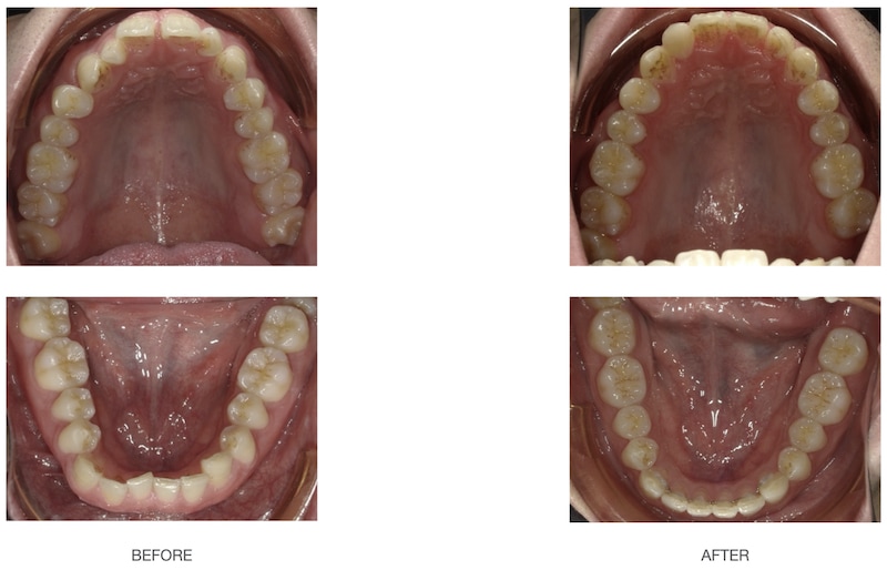 隱適美-隱形矯正-深咬-前牙反咬-牙縫大-牙齒矯正前後-台中隱適美推薦-楊念珊