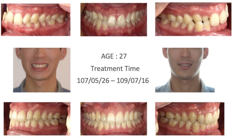 隱適美-隱形矯正-深咬-前牙反咬-牙縫大-牙齒矯正前後-牙齒變化-台中隱適美推薦-楊念珊