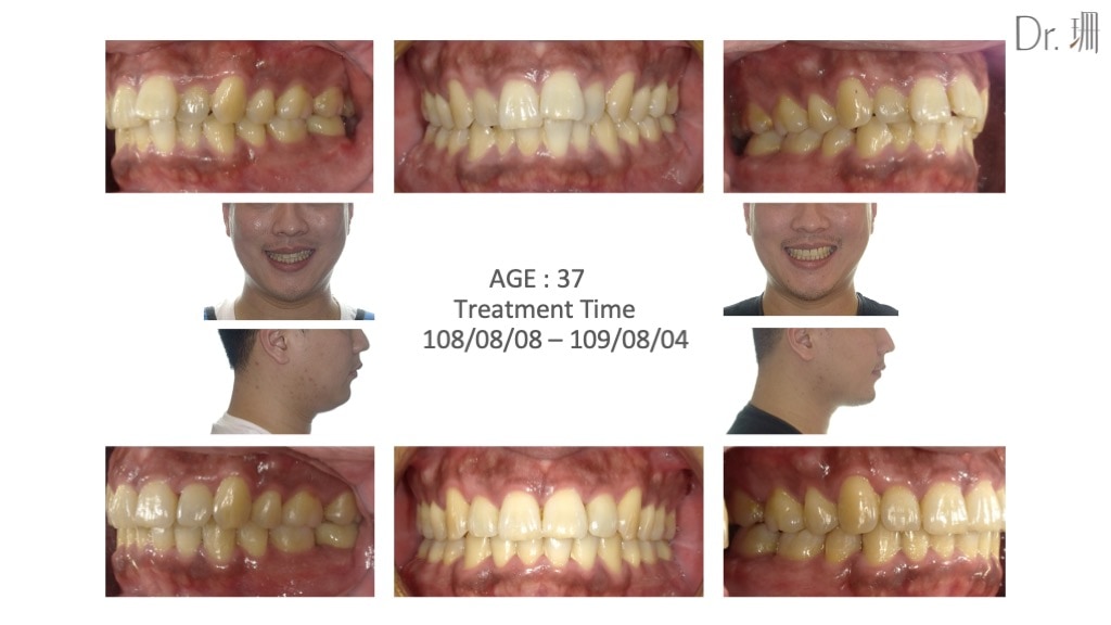 隱適美-隱形矯正-牙弓窄-門牙飛-牙齒矯正前後-牙齒變化-台中-楊念珊